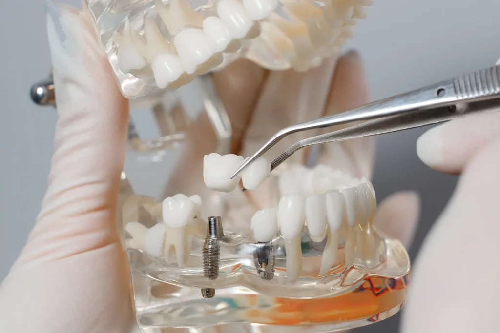 Dental Implants Kuwait