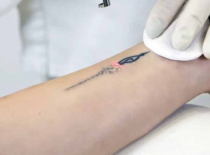 Tattoo Removal Pico Laser Pigmentation Treatment