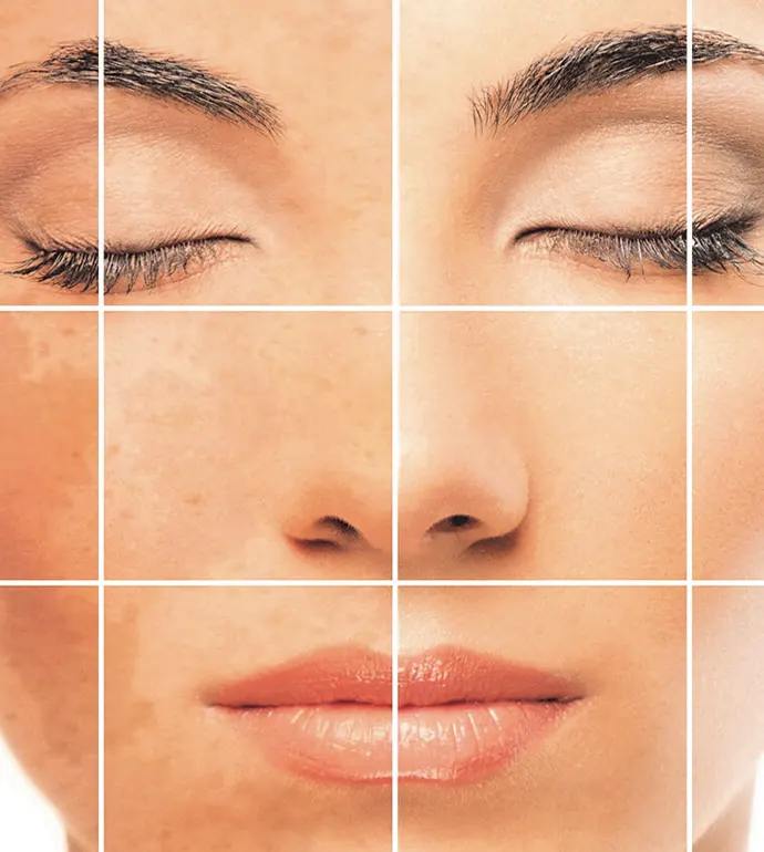How to prepare for laser pigmentation removal