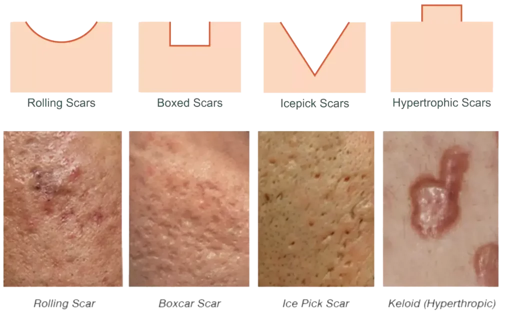 Acne Scar Removal in Kuwait